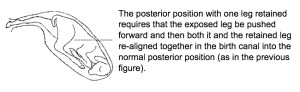 Posterior position with on leg retained.